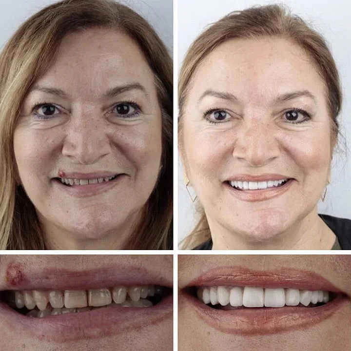 SecureSmile – Tandproteser med stærk binding